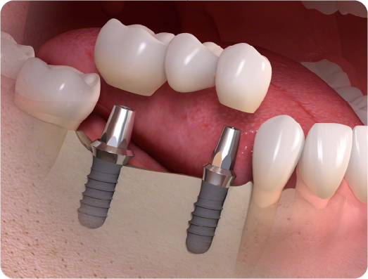 当院のインプラント治療